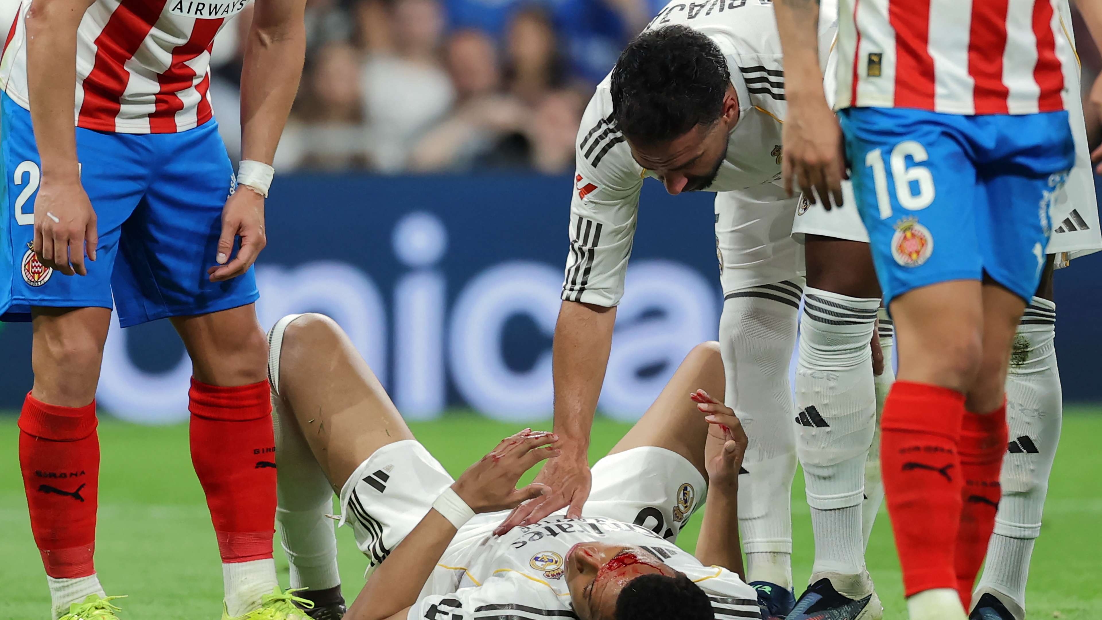 Mbappé’s “stitches” keep him out of Real Madrid training… Will he miss the match against Bayern?  